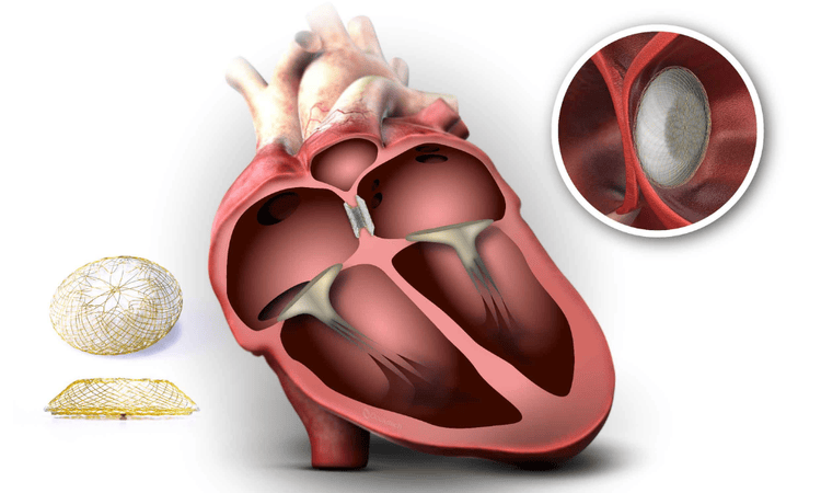 ASD VSD PDA Device Closure