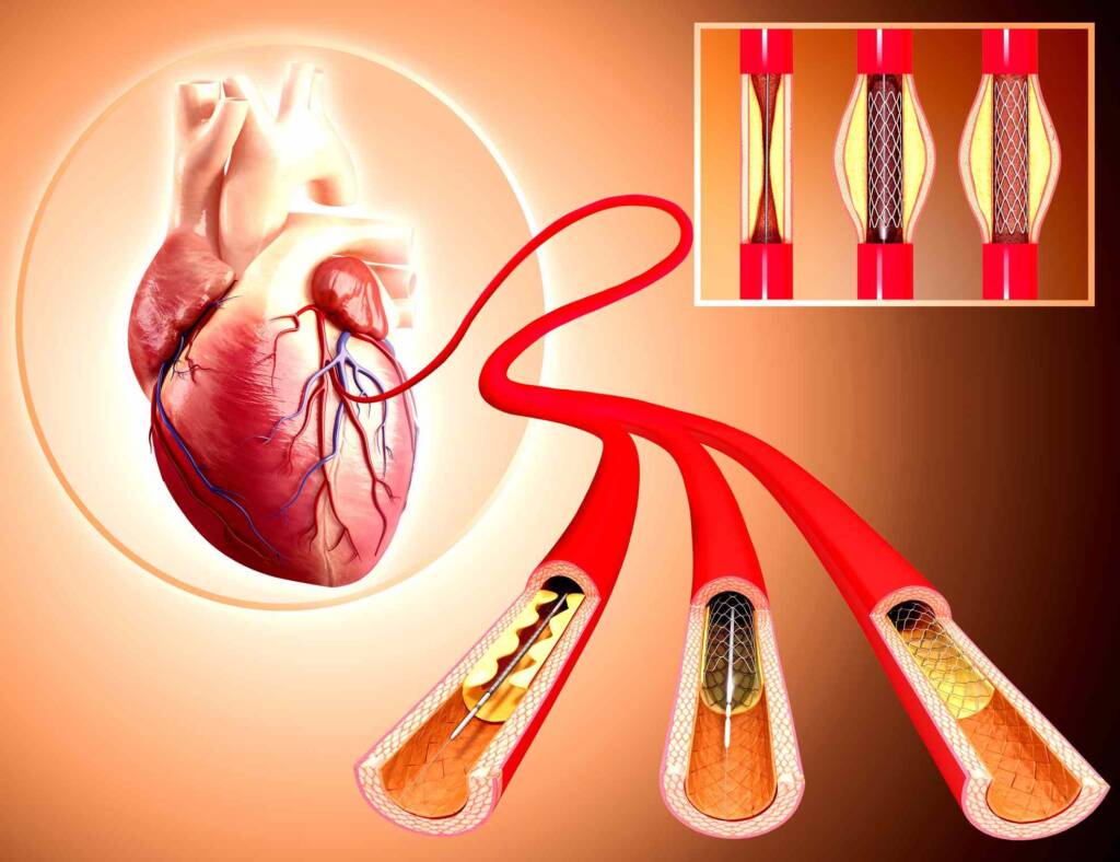 Complex Coronary Angioplasty