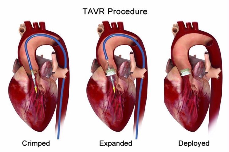 TAVI TAVR Surgery
