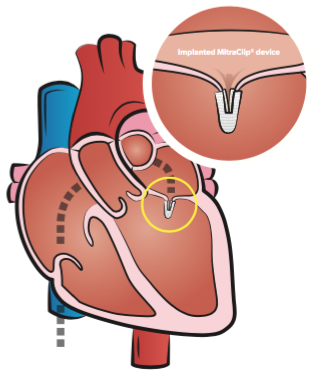 Diagram showing how MitraClip clips the mitral valve leaflets