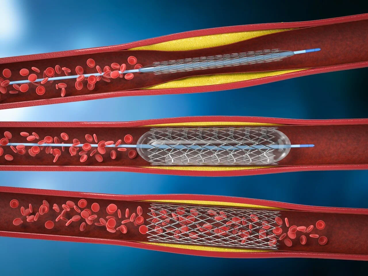 Peripheral Vascular Disease Angioplasty